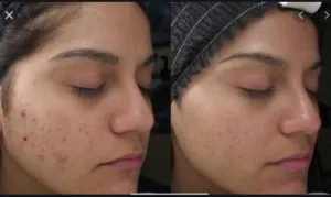 Benzoxin Krem Nasıl Kullanılır